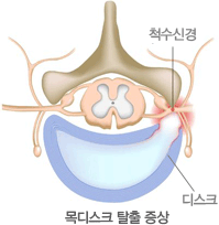 목디스크탈출증상